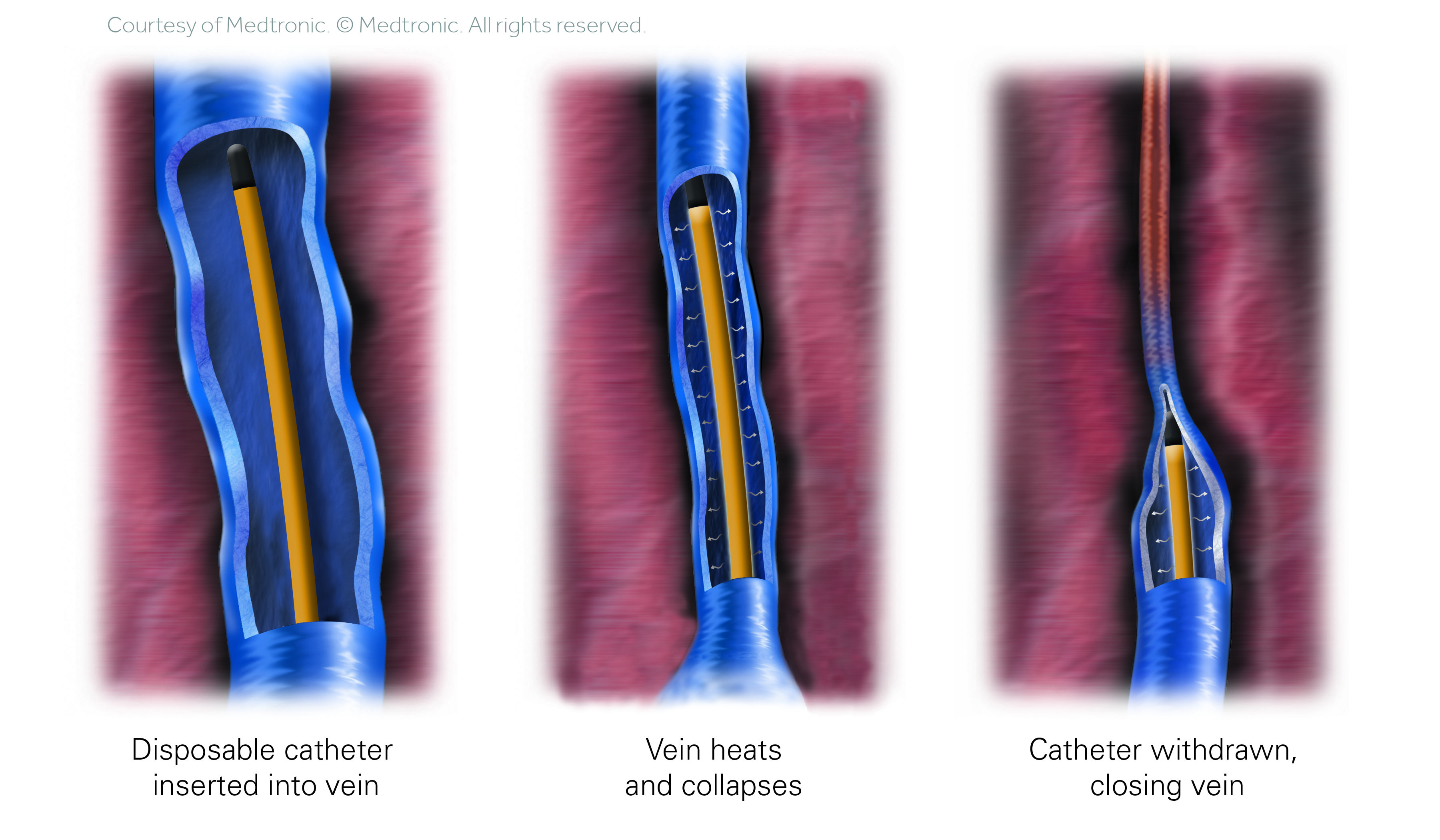 Procedure Illustration