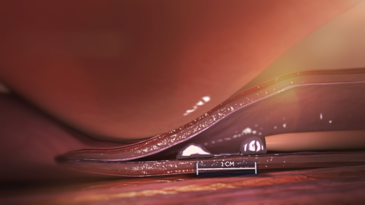 Venaseal 2