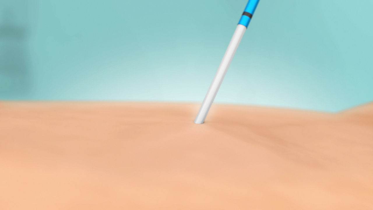 Procedure Illustration