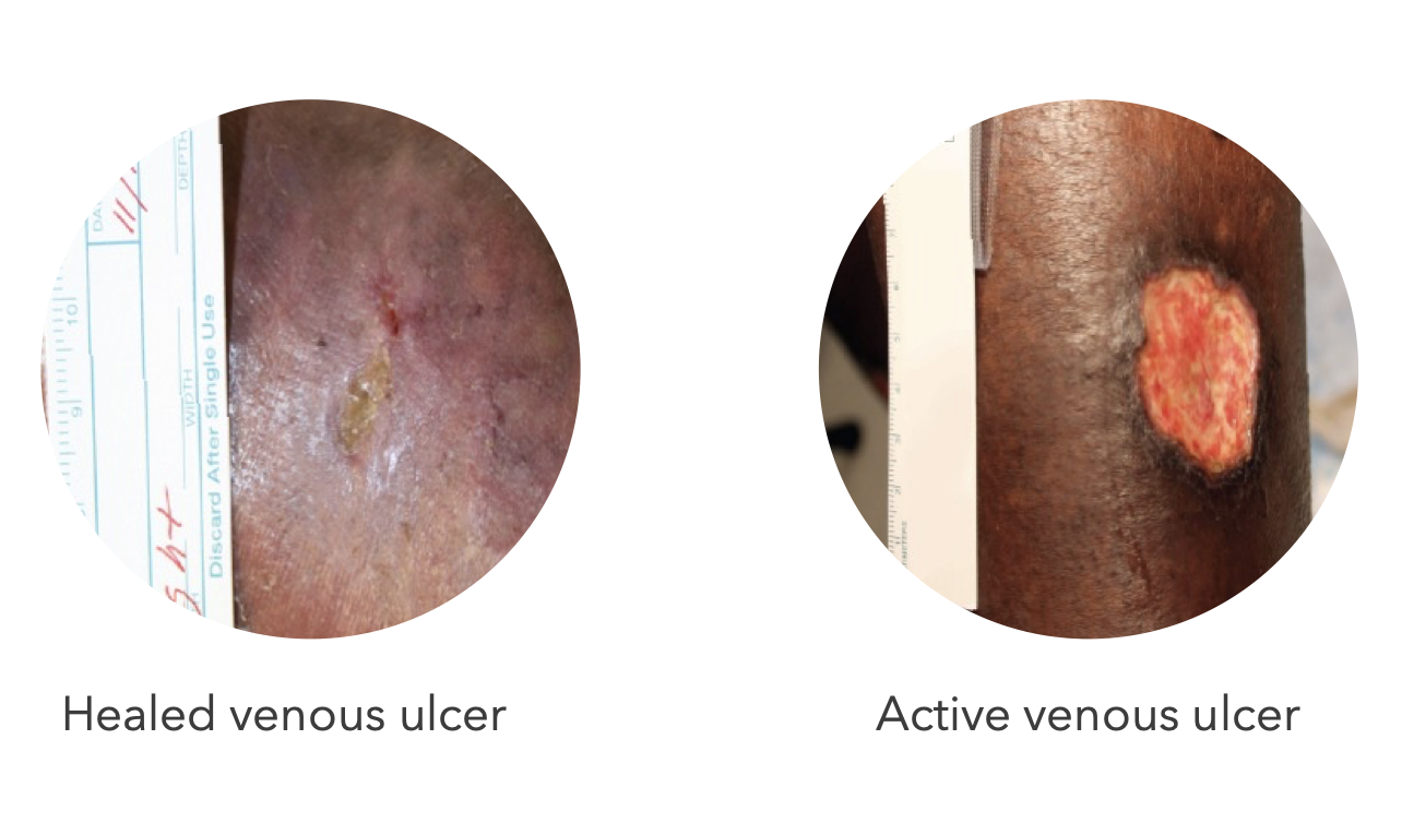 Venous Ulcers