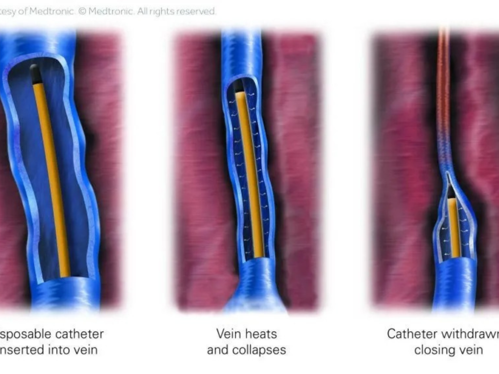 radio frequency ablation veins