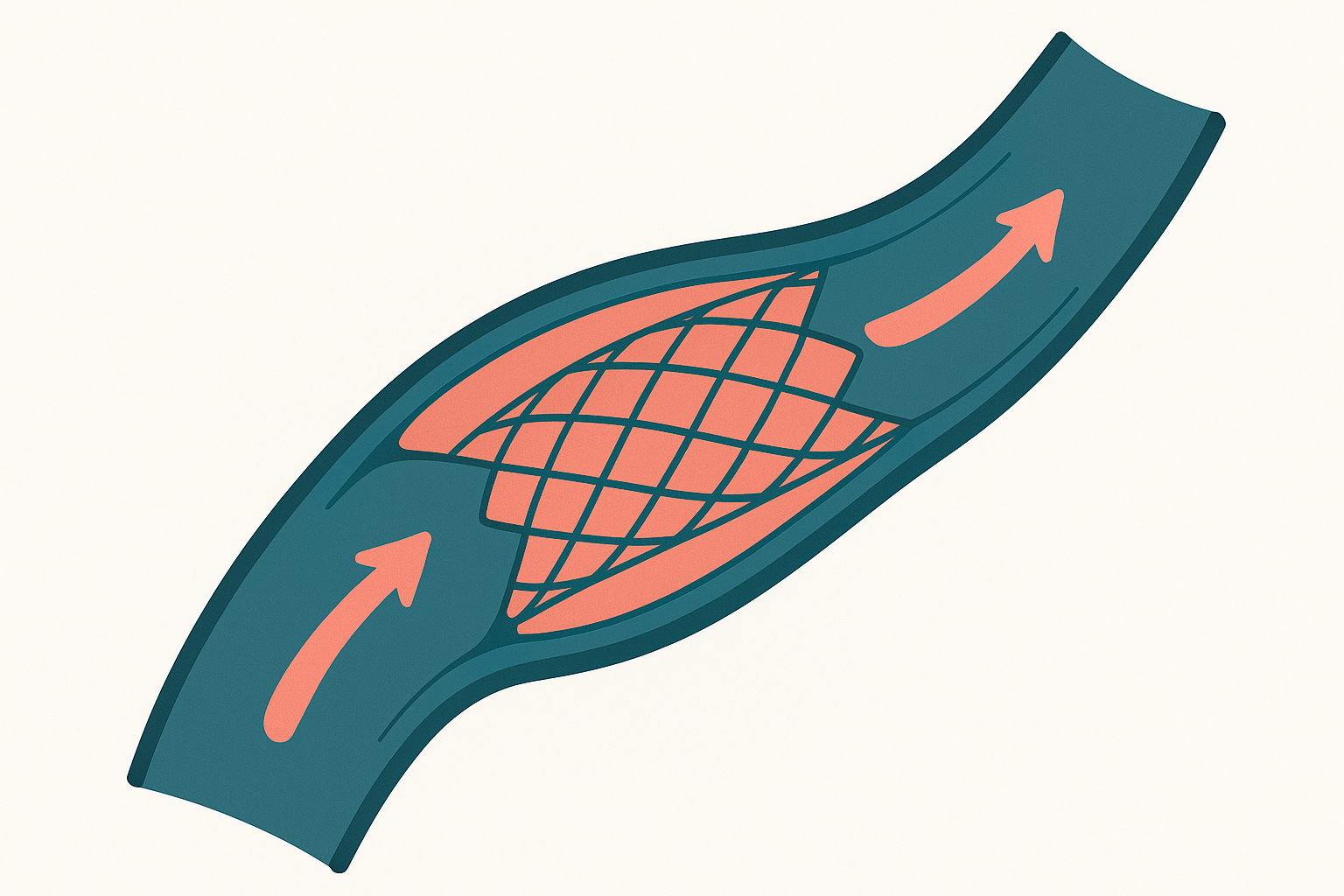 Cross-section illustration of an iliac vein with a mesh stent holding the vessel open to restore blood flow