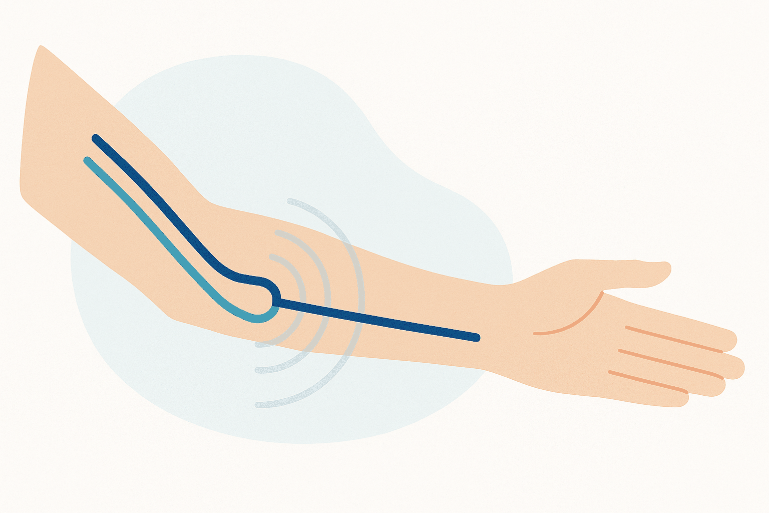 Illustration of a forearm showing an arteriovenous dialysis access joining an artery and vein, with vibration waves representing the thrill